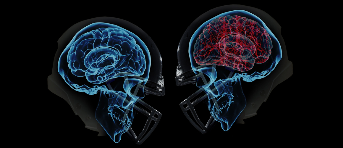Concussions in Sports Impacting School Athletic Programs - Gamebreaker Headgear